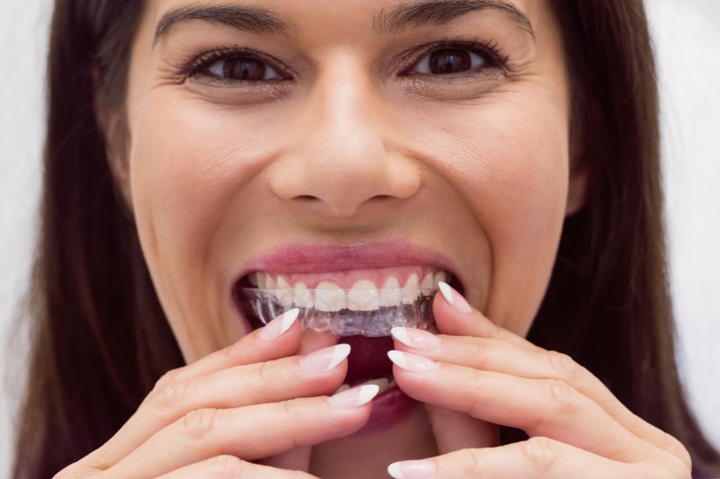 The Ultimate Guide to Invisalign in Torrance for Families